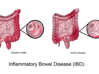 Inflammatory bowel disease - A guide to ibd symptoms