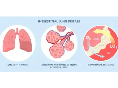 Interstitial lung disease - A complex group of disorders