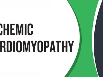 Understanding Ischemic Cardiomyopathy causes and risks