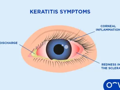 Acanthamoeba keratitis - A risk for contact lens wearers
