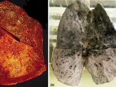Optimal treatment for invasive Kingella kingae infection