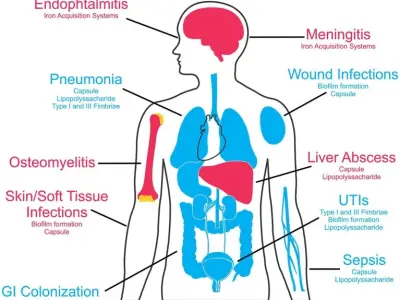 The rise of carbapenem - Resistant Klebsiella pneumoniae Infection