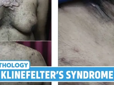 The impact of Klinefelter syndrome on fertility and health