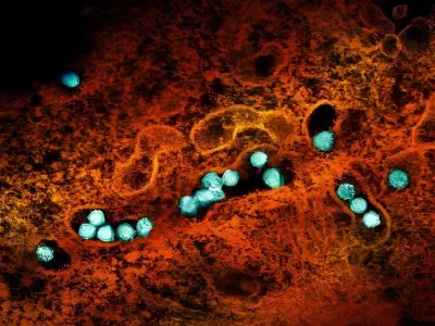 Understanding la crosse encephalitis symptoms and risk