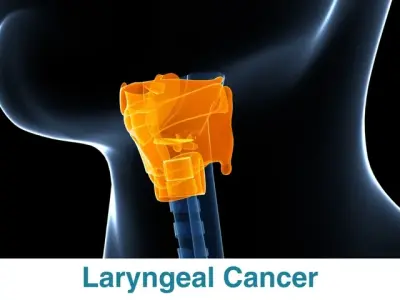 Laryngeal cancer - When a hoarse voice is a serious warning sign