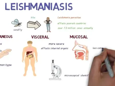 Understanding leishmaniasis and sand fly bites