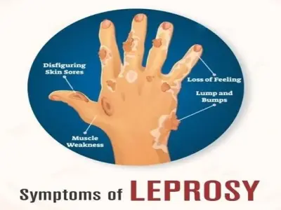 Leprosy - Early diagnosis prevents long-term disability