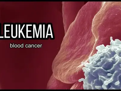 Leukemia - Understanding this complex cancer of the blood