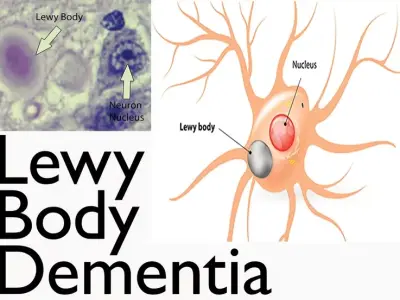 Understanding the unique symptoms of lewy body dementia