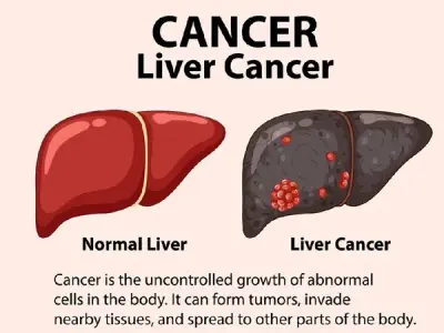 Liver Cancer - Screening in high-risk populations