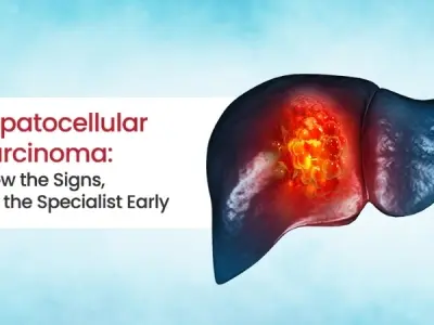 Understanding liver cancer (hepatocellular carcinoma) risks