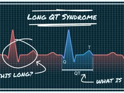 Long QT Syndrome (LQTS) overview for better health