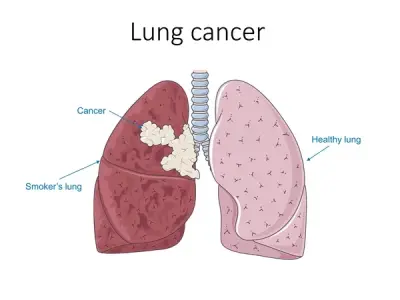 Navigating the different stages and types of lung cancer