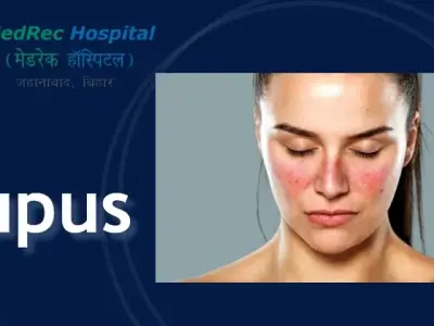 Recognizing the butterfly rash and other common signs of lupus