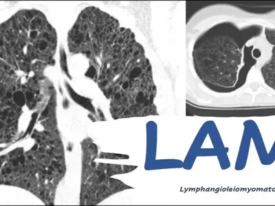 Lymphangioleiomyomatosis (LAM) - A rare lung disease in women