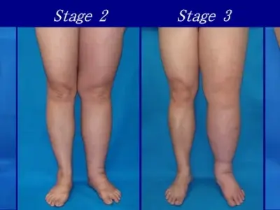 Lymphedema - Understanding chronic swelling condition