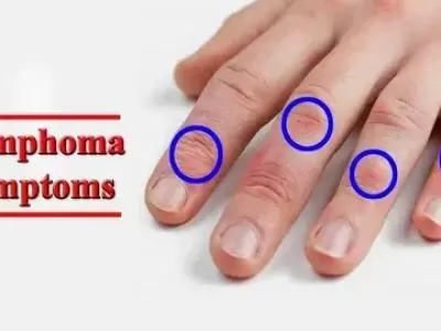 How lymphoma is diagnosed and staged for effective treatment