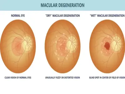 Macular degeneration - Understanding AMD and its types