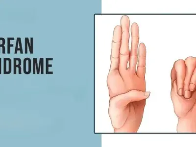 Key facts about marfan syndrome symptoms and complications