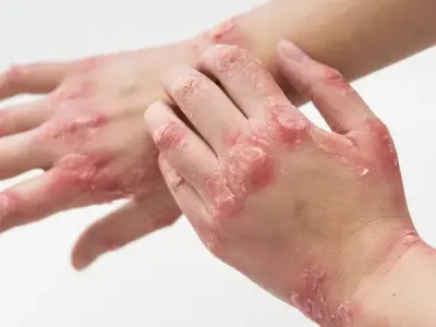 Measles explained - A guide to prevention at home