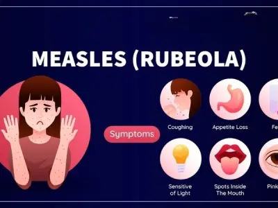 Measles (Rubeola) symptoms causes and prevention tips