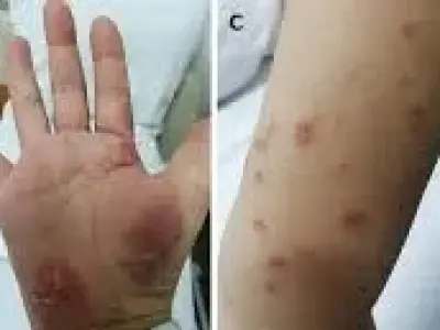 Environmental exposure and risks for acquiring melioidosis