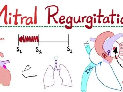 Understanding Mitral Regurgitation (Insufficiency) symptoms