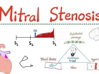 How Mitral Stenosis affects the heart and treatment ways