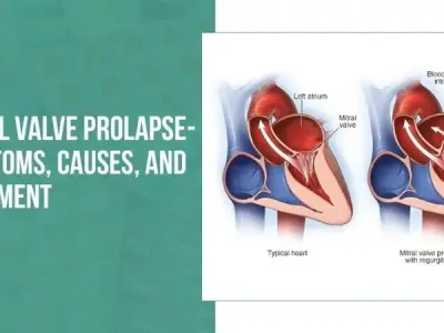 Mitral valve prolapse causes symptoms and treatment