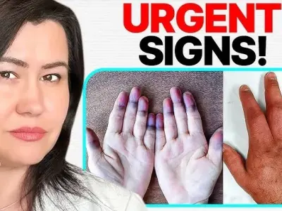 Mixed connective tissue disease - A comprehensive guide