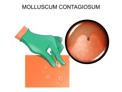 Managing molluscum contagiosum in pediatric patients