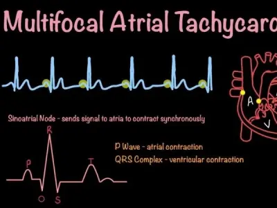 Multifocal atrial tachycardia risks and management tips