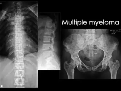 Multiple myeloma - A cancer of the plasma cells explained