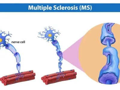 Recognizing the early and often subtle signs of multiple sclerosis