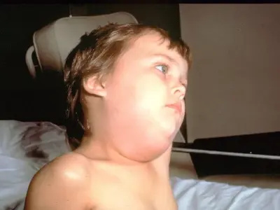 What is mumps? Signs you should know