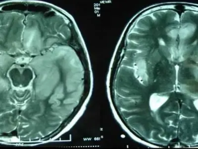 How to prevent and detect Murray Valley Encephalitis early