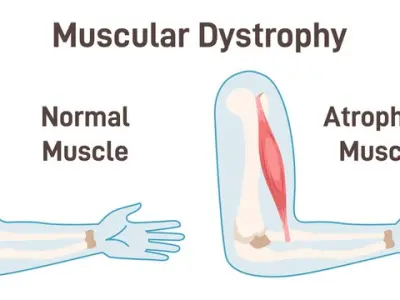 Muscular dystrophy- A guide to the different types and stages