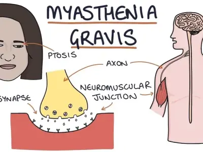Myasthenia gravis - An autoimmune neuromuscular disease