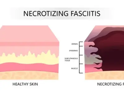 Necrotizing fasciitis - A critical soft tissue infection