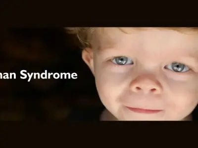 Understanding symptoms and causes of Noonan Syndrome