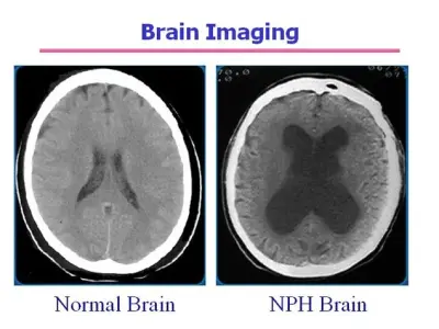 Normal pressure hydrocephalus - A guide to nph symptoms