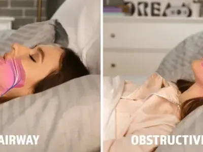 Obstructive sleep apnea - Why you should never ignore snoring