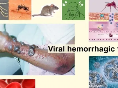 Understanding omsk hemorrhagic fever symptoms and risks