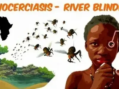 What is onchocerciasis? A guide to river blindness