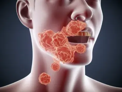 Oral cancer - The importance of early detection and screening