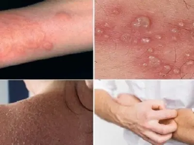 Understanding Orf (Contagious Ecthyma) symptoms and care