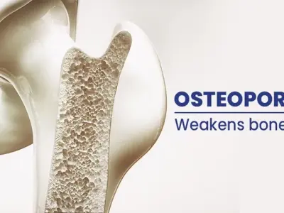 Osteoporosis - The silent disease that weakens your bones
