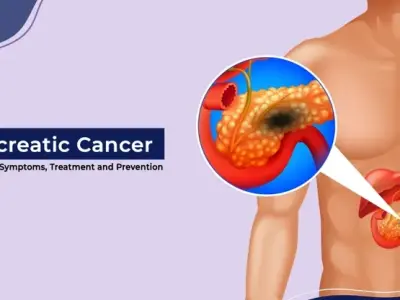 New hope in treatments for advanced pancreatic cancer