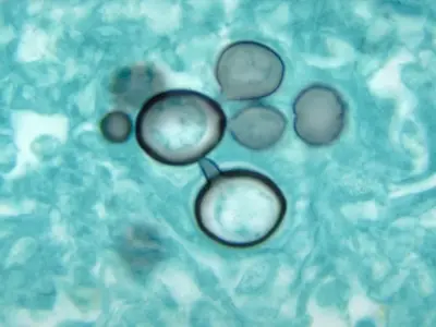 Diagnosing chronic paracoccidioidomycosis infection
