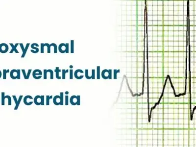 Common paroxysmal supraventricular tachycardia symptoms
